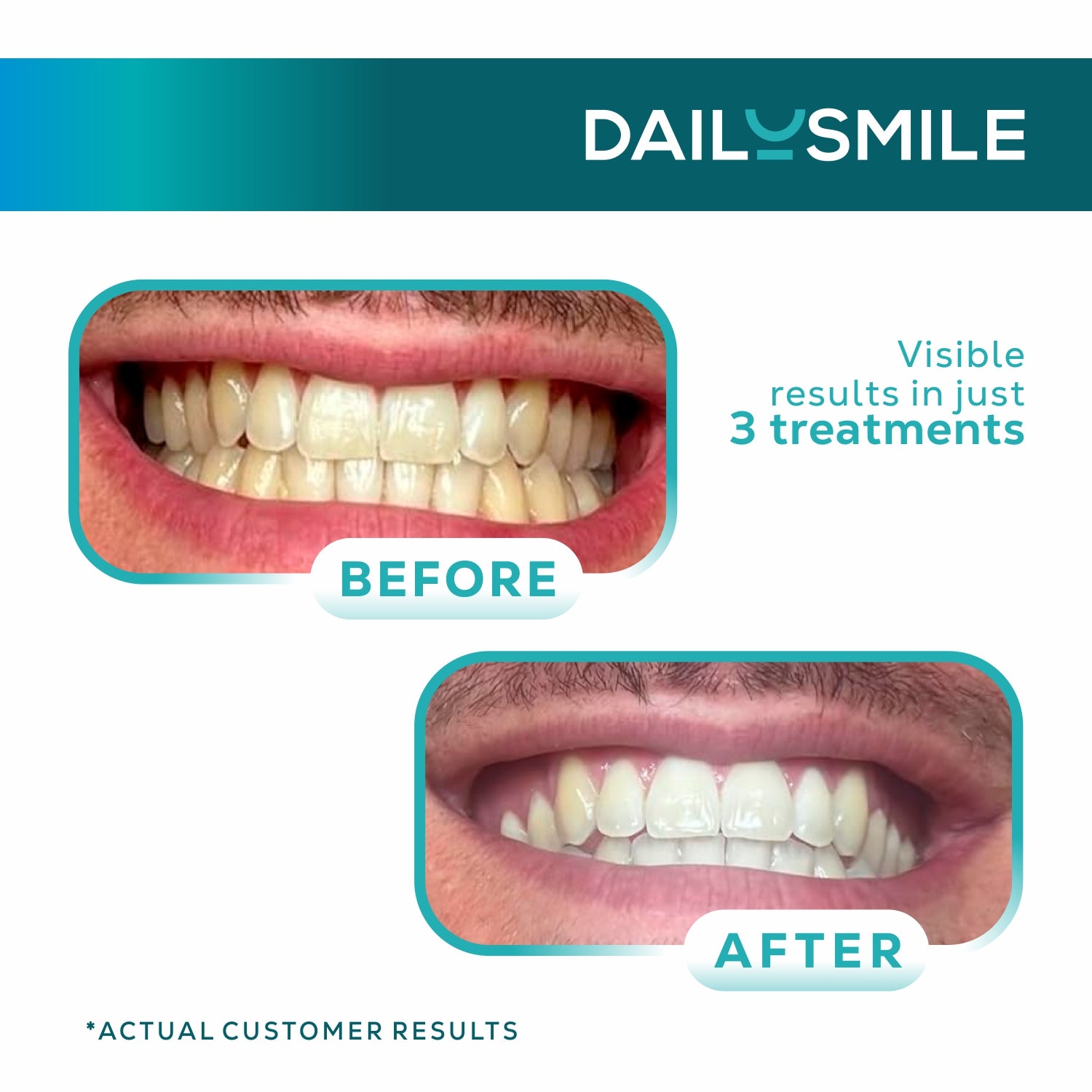DailySmile Teeth Whitening Kit with LED Light